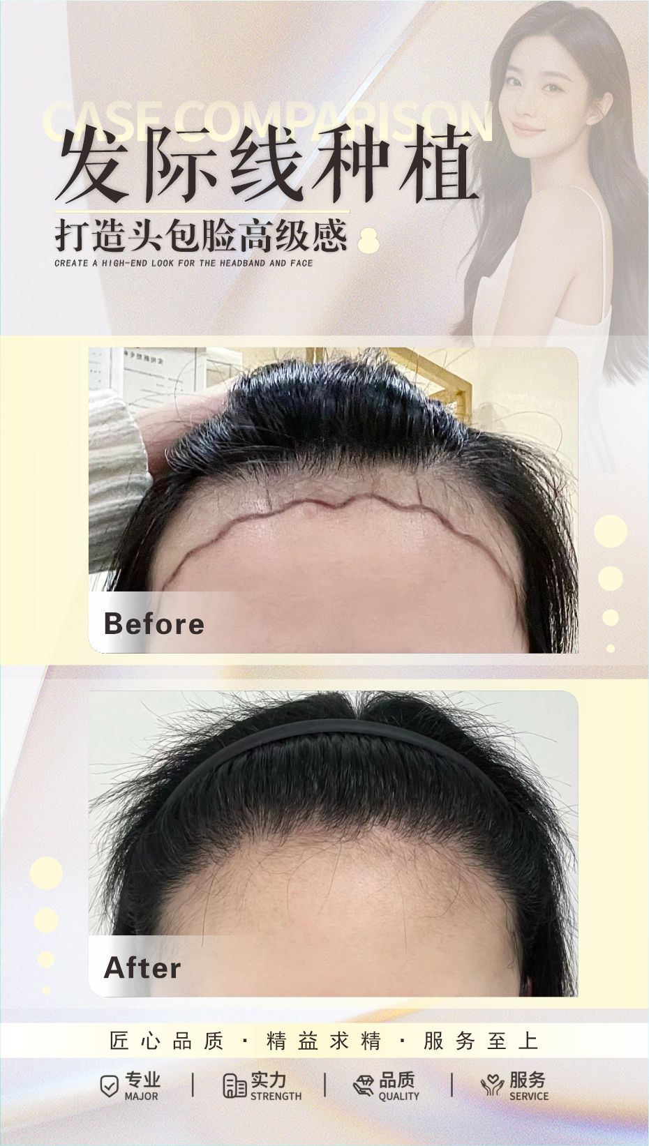 FUE 植发案例