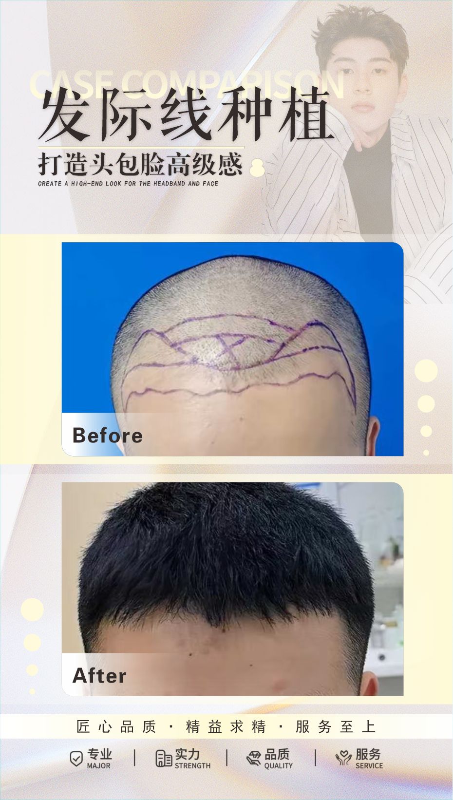 FUE 植发案例